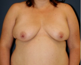 Feel Beautiful - Breast Augmentation Lift 61 - Before Photo